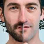 Пересадка волос на бороду: описание метода, техника выполнения, особенности, отзывы