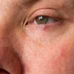 Удаление сосудов на лице лазером: отзывы, описание процедуры, противопоказания. Купероз на лице: причины и лечение