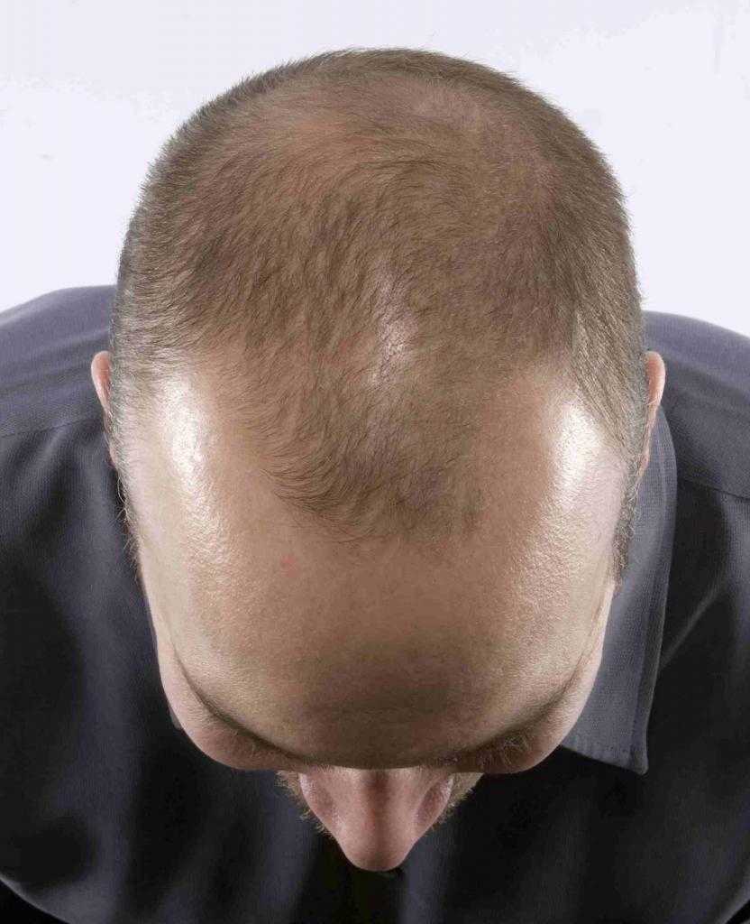 рост волос на голове у мужчин