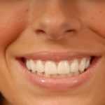 Как избавиться от щели между зубами