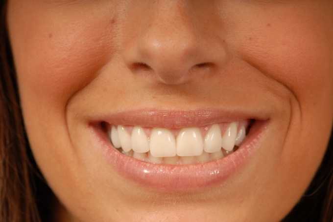 Как избавиться от щели между зубами